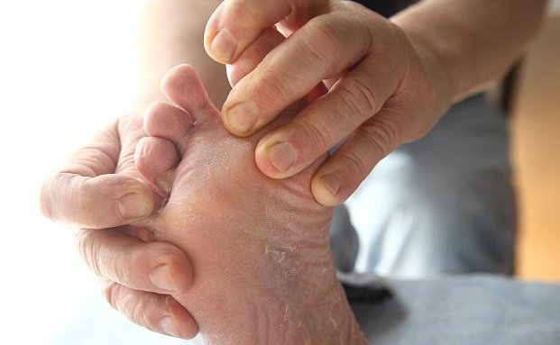 脚气怎么治疗能除根 偷偷告诉你11个有效去脚气的方法 快资讯