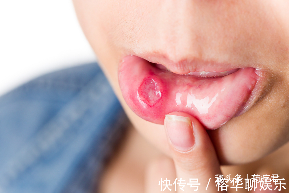 口腔溃疡|嘴巴里隔一段时间就要长溃疡,这是什么原因听听医生怎么说