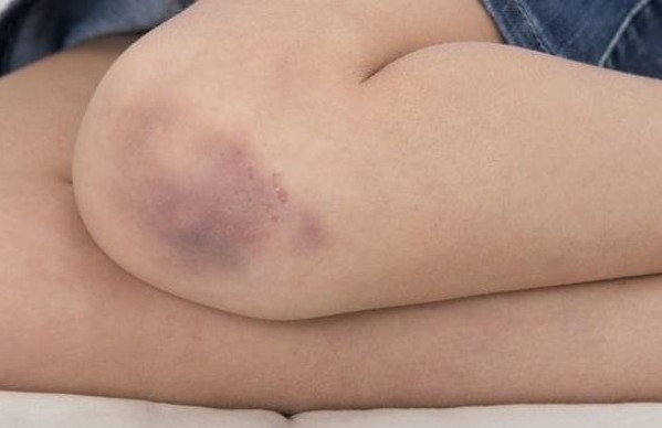 皮肤|身体一碰就淤青,可能患上了此3种病,男女都应该了解