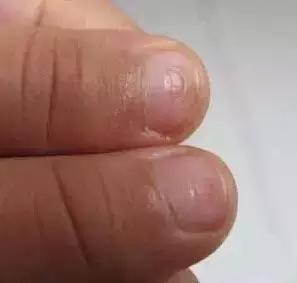 匙状甲|宝宝指甲中,隐藏着哪些关于健康的小秘密