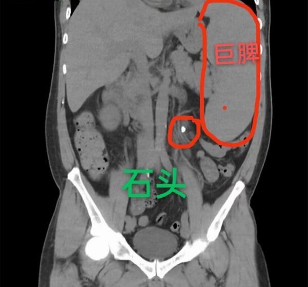 保脾|“巨脾”男子成功保脾，专家:不明原因腰胀痛,可能是肾结石