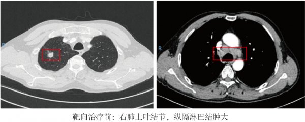 达芬奇|靶向治疗“降期”后重获手术机会，肺癌晚期男子术后3个月再渡江