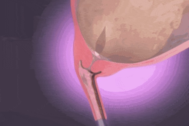 宫口|顺产到底有多疼,给你们看完这18图片,就能真正理解女人不容易