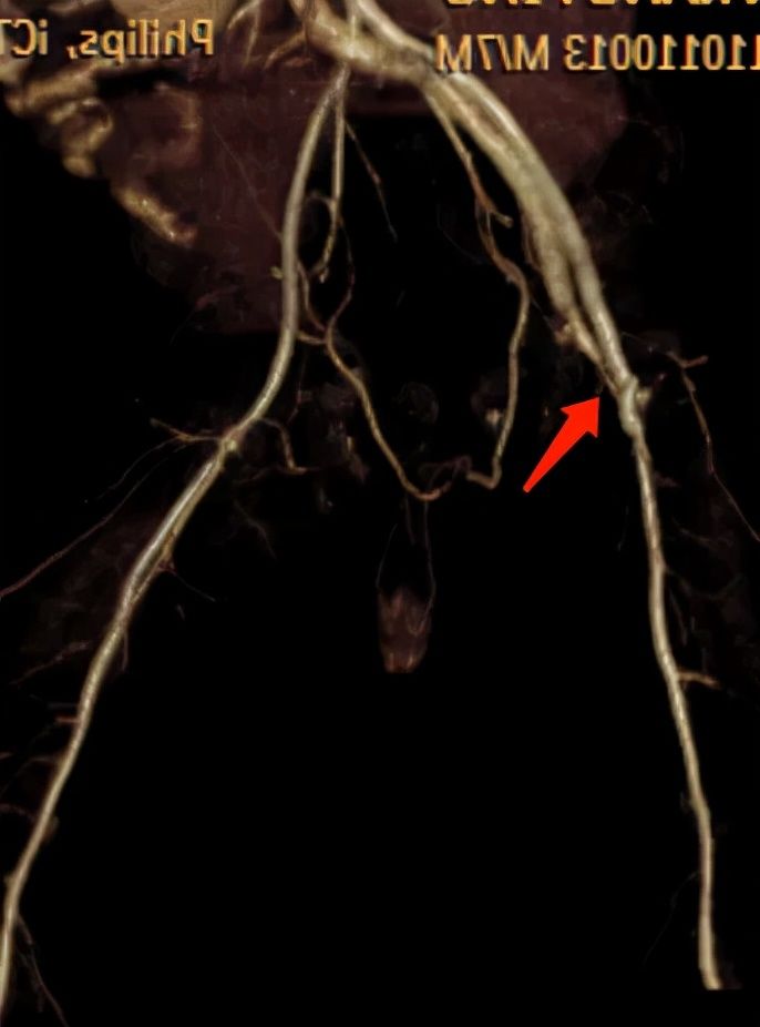 icu|宝宝左腿比右腿大一圈，家长以为发育有问题，竟是进过ICU留下的血管病