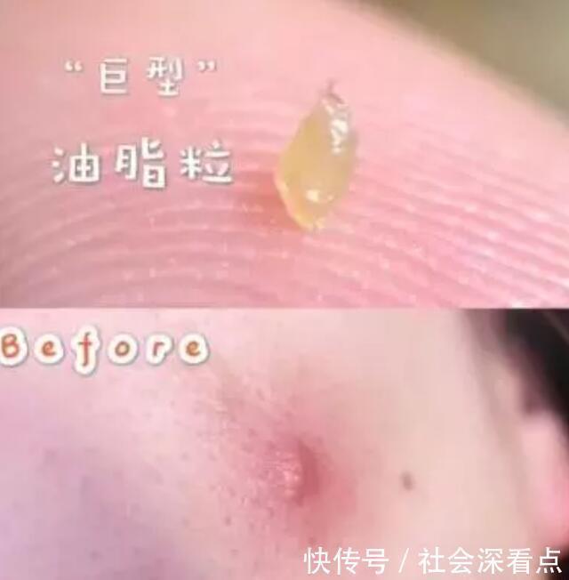 后背经常长黄色“小米粒”一抠一个坑,一个小妙招,荡平后背痘痘