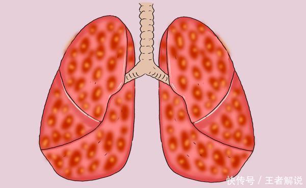 可能性|肺癌患者术后复发，还可以再次手术吗？别着急，综合评定后再决定