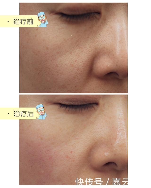 收敛毛孔，除了光子嫩肤，这两种方法也很出色