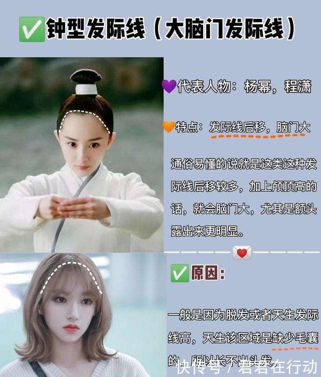 三角形 几种常见的发际线,你又是哪一种呢几分钟教你植发如何选发际线!