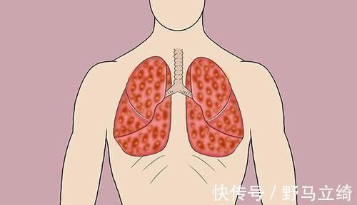 支气管|肺内有没有癌,咳嗽先知晓?咳嗽时有2个异常,肺癌或已登门