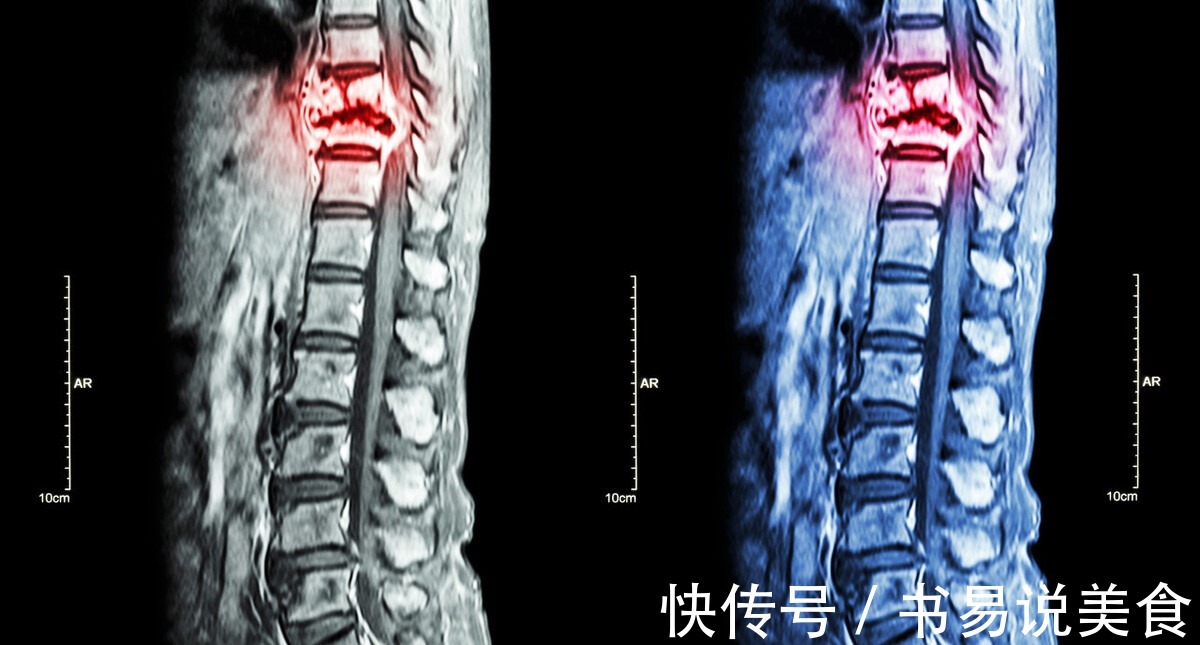 疼痛|肺癌患者出现骨转移时有什么症状为什么有人骨转移了也不痛