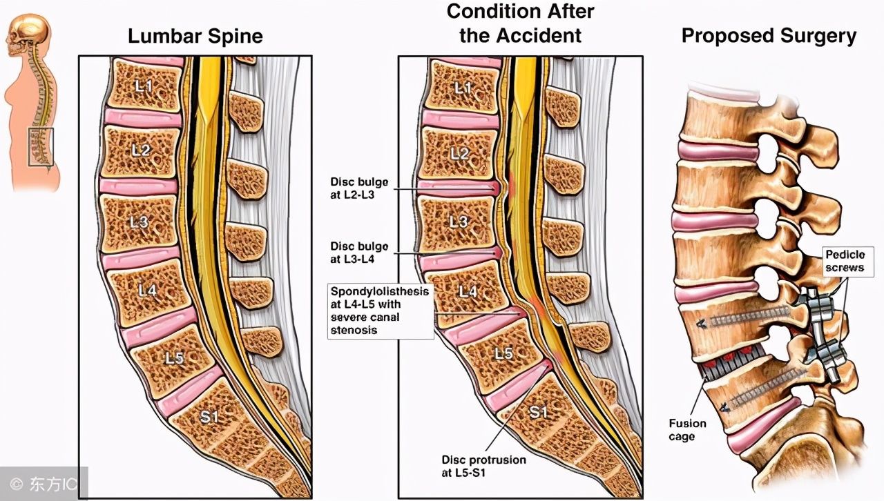 手术治疗|路医生说丨“腰椎滑脱”，究竟是个什么鬼，是腰椎脱位了么？