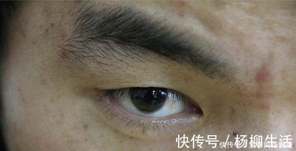 蜘蛛痣|肝病先上脸，脸部出现什么变化，暗示肝脏病得不轻了？别大意