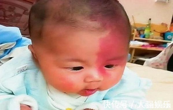 产科医生|胎记咋来的产科医生除了遗传,还与孕期的这3种行为有关