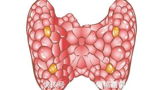 甲状腺结节患者|甲状腺结节患者，多吃这3种食物，化瘀散结，结节慢慢就消失了！