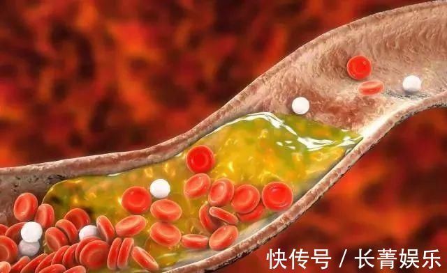 偏高|甘油三酯偏高,少碰2黄,多吃2果,摒弃2习,血脂或慢慢往下降