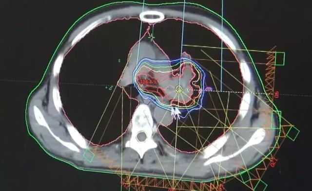 放疗|左肺被肿瘤堵死缩成一团，放疗后吐出一块“鱼肉”，肺瞬间充满
