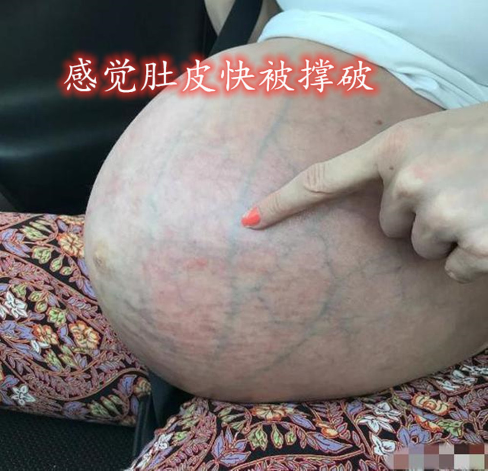 腹白线|丹麦妈妈怀上三胞胎,产后肚皮却“收不回去”,看完照片感同身受