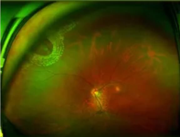 黑点|眼前有小黑点别不当回事，可能是视网膜脱离的第三部曲