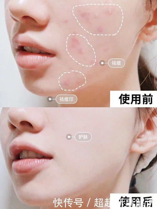 毛孔|爱长“闭口粉刺”的女生,每天坚持做这件事,皮肤白白净净又细腻