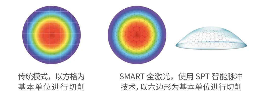 角膜|近视手术该不该做?怎么选?一文给你讲清楚