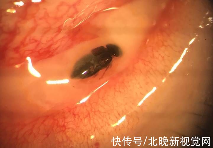 虫子|50岁大妈眼内竟有一只“苍蝇”？！医生：幸运的是……