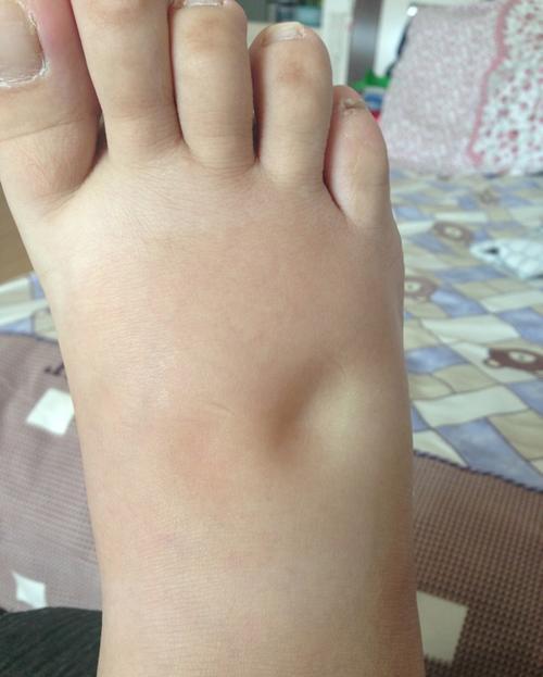 生理性水肿|10个孕妈9个肿,孕期水肿做好这几点,让你告别“大猪蹄子”!