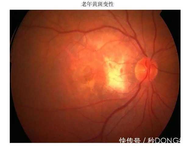 近视引起的这4大并发症,竟然还有这样的危害!