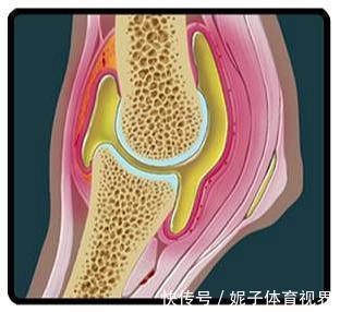 患者|膝盖疼，就是得滑膜炎了？医生辟谣，教您一步步判断自己的病因