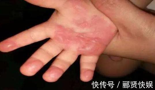 胶水|儿子误拿胶水滴眼睛,宝妈用30秒保住了娃眼睛,医生饭碗不保了