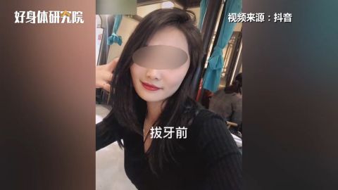 女子连拔3颗智齿肿成松鼠脸 专家称智齿若端正不用拔