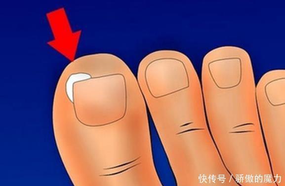  指甲沟炎症|甲沟炎究竟是何方妖孽为何总是折磨我