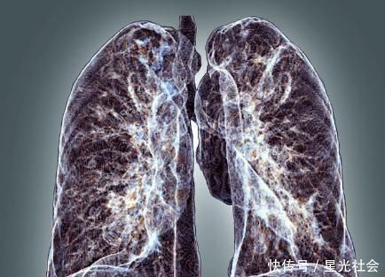 上门|肺部长了三种结节，最好及时手术切除，不然癌症有可能会找上门