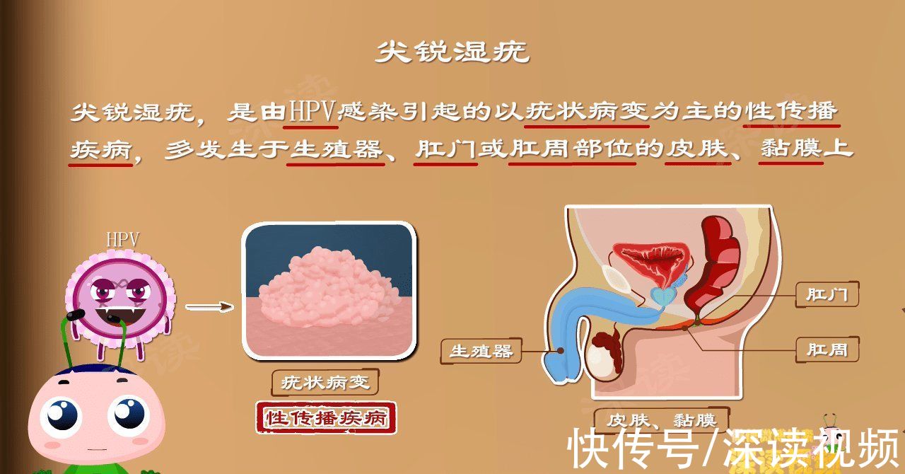 尖锐湿疣|明明没出轨，为啥染上尖锐湿疣？有哪些你不知道的事会招惹HPV？