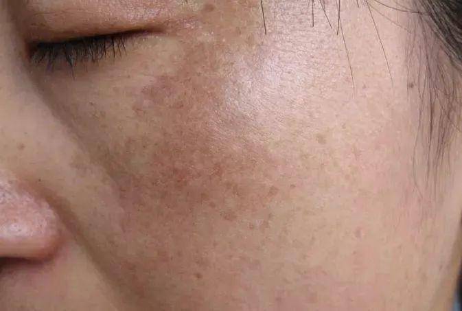 反黑 做完光子嫩肤之后反黑了怎么办呐?什么是反黑?术后该如何护理?