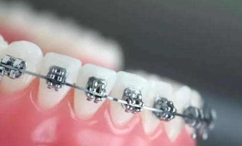 黄金期|孩子牙齿矫正,必须要12岁以后吗?你是否错过了孩子的矫正黄金期