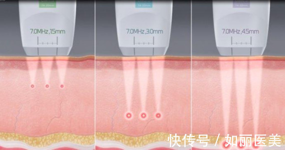 超声提升 热玛吉&超声提升，谁是抗衰NO.1？抗衰选它就对了！