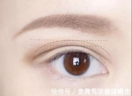 重睑线 眼修复孙沣博士:双眼皮术后是否会产生疤痕和增生?