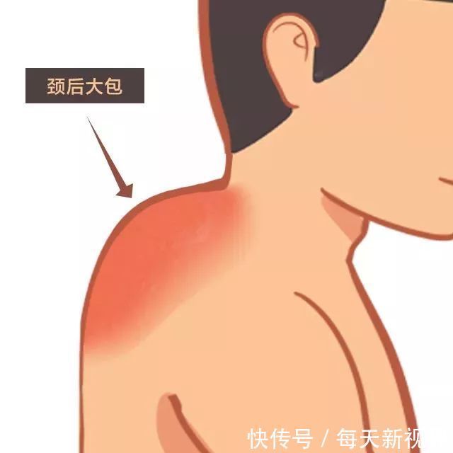 富贵|富贵包=“夺命包”?危害可不小!你中招了吗?