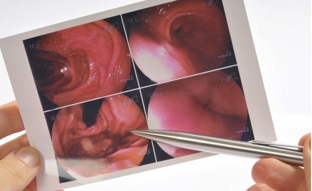 专家建议|17岁男生查出肠癌晚期,丧失手术机会!父母还以为仅仅是吃坏肚子