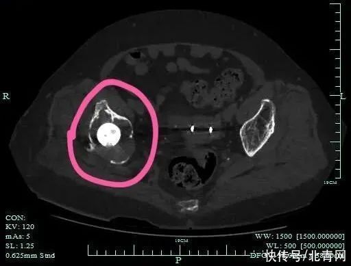 长时间|72岁奶奶骨头被“吃了”？医生：千万别忽视这件小事