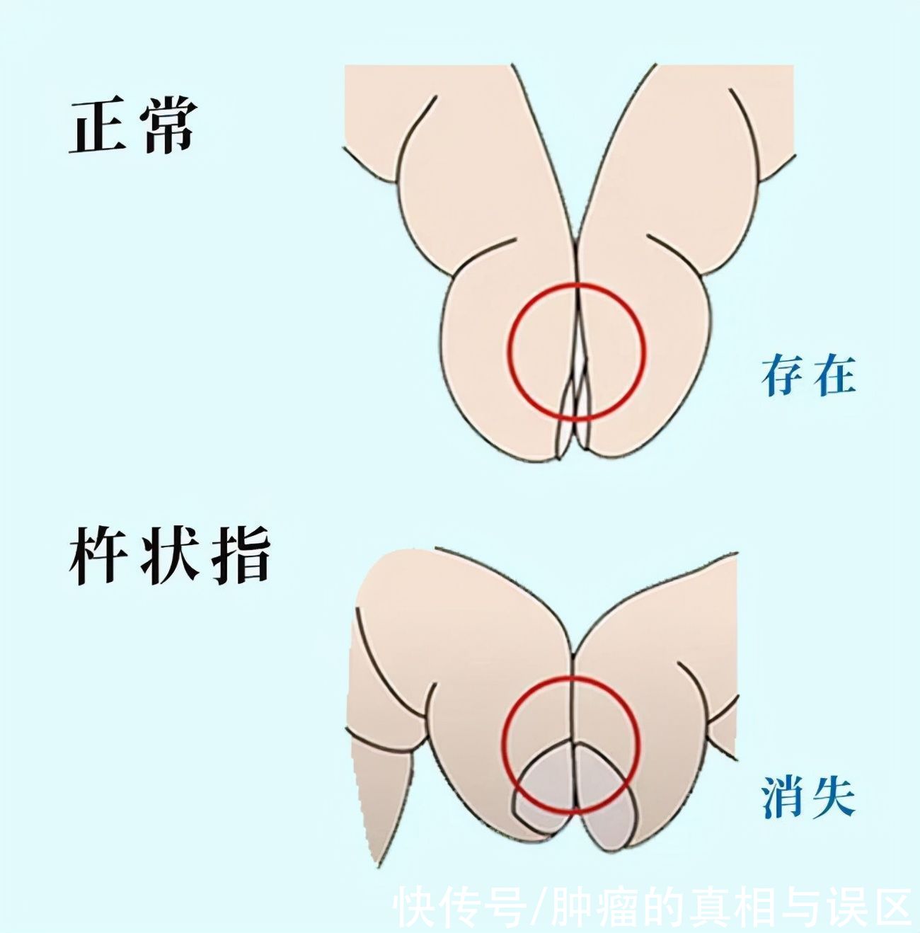 银屑病|从手指也能看出肺癌？提醒：手指出现5个异常，赶紧排查病因