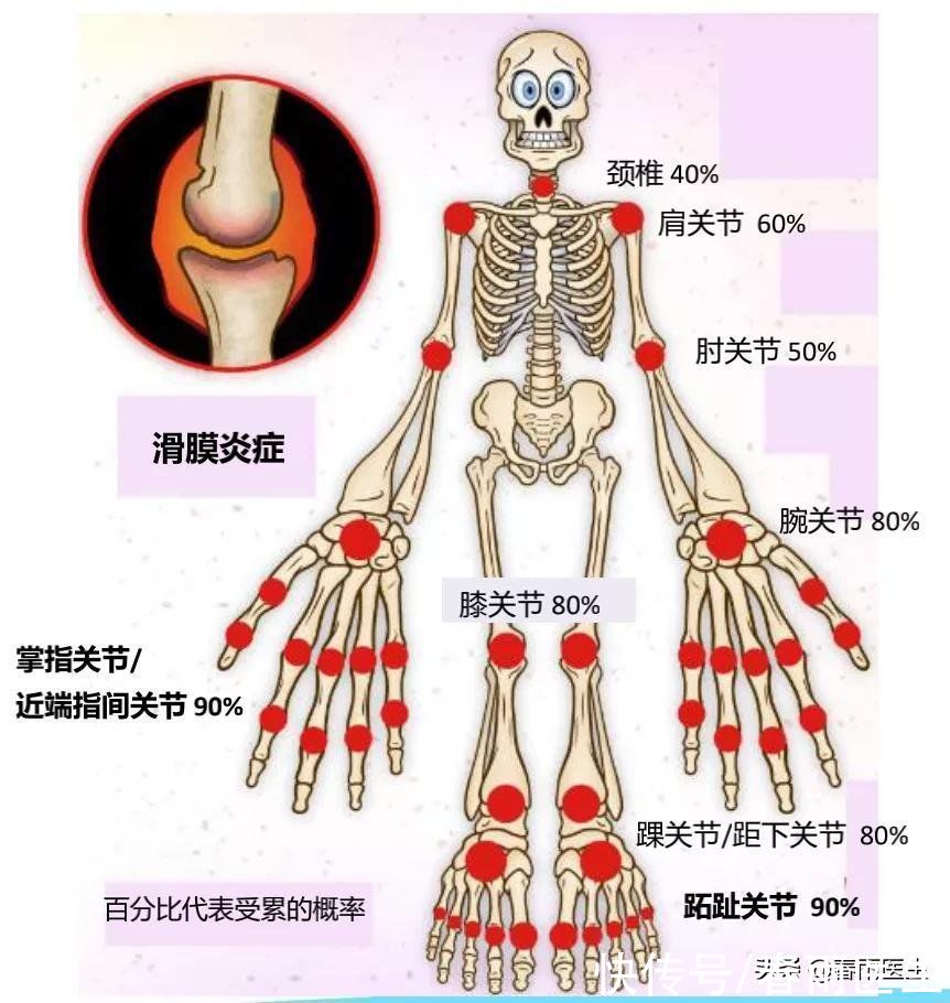 类风湿|早上起床手指僵硬疼痛？警惕类风湿找上门