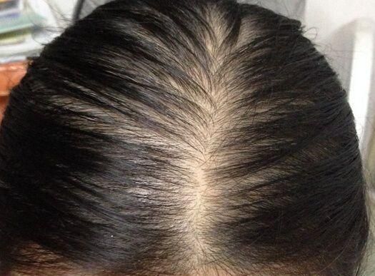 中老年人|原来头皮也会衰老?麦吉丽提出头皮衰老论,这么多年头发白洗了!