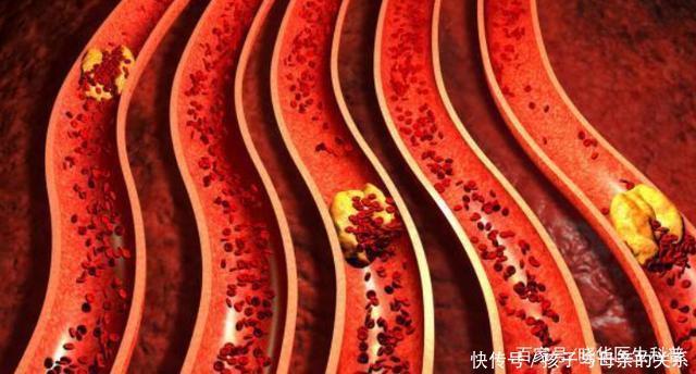 堵不堵|血管堵不堵,看手就知道!若手上出现4个异常,当心血栓“扎根”