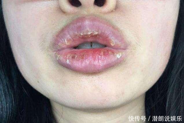 喝水|嘴唇总是干裂没亮泽不只是缺水,还跟缺乏一种营养素有关