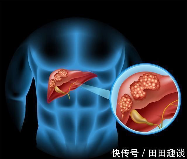 肝性脑病|一旦身体发出7个信号，十有八九是肝硬化，最好检查一下