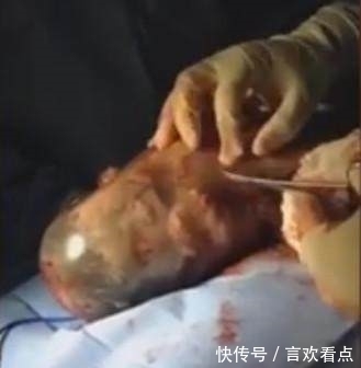 羊膜囊|巴西女子生下“魔力宝宝”,在场所有医生都惊呆了