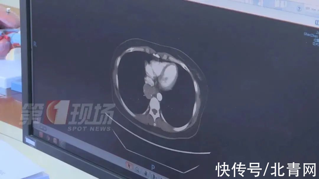 王哲|女子手指肿成“萝卜头”，一查竟是肺癌！警惕身体这些信号