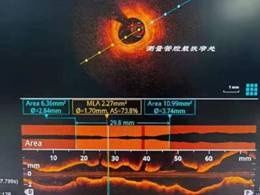 冠脉介入治疗|市中心医院完成营口地区首例在OCT指导下冠脉介入治疗