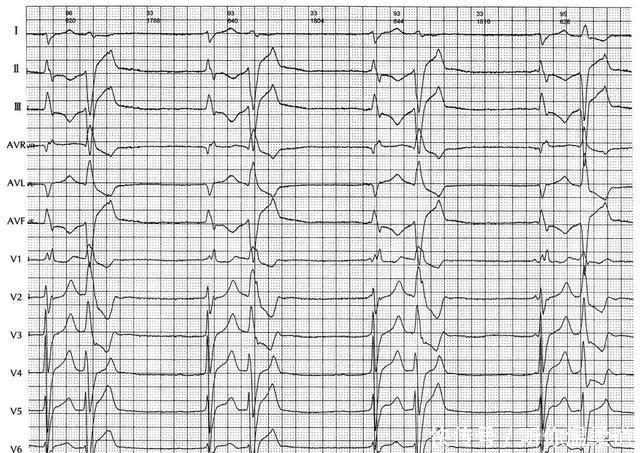  临床资料|心电图读图每日一练，提高诊断水平，第3题（含第2题答案）